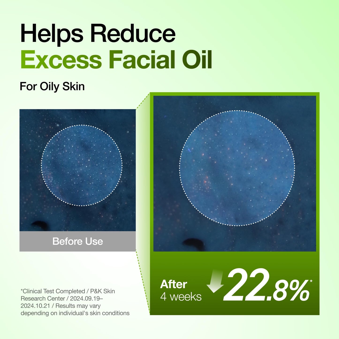 Anua Azelaic Acid 10 Hyaluron Redness Soothing Serum, Facial Serum for Blemish-Prone & Oily-Prone Skin, Lightweight & Hydrating Blemish Care